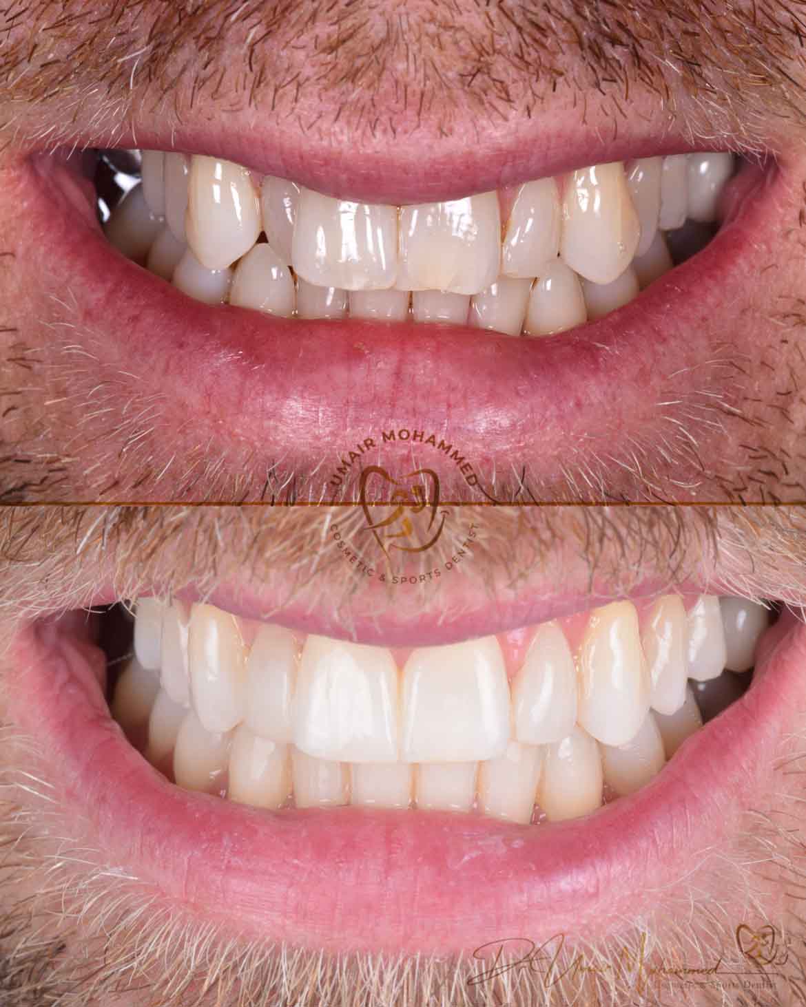 Before and After Patient Teeth 11
