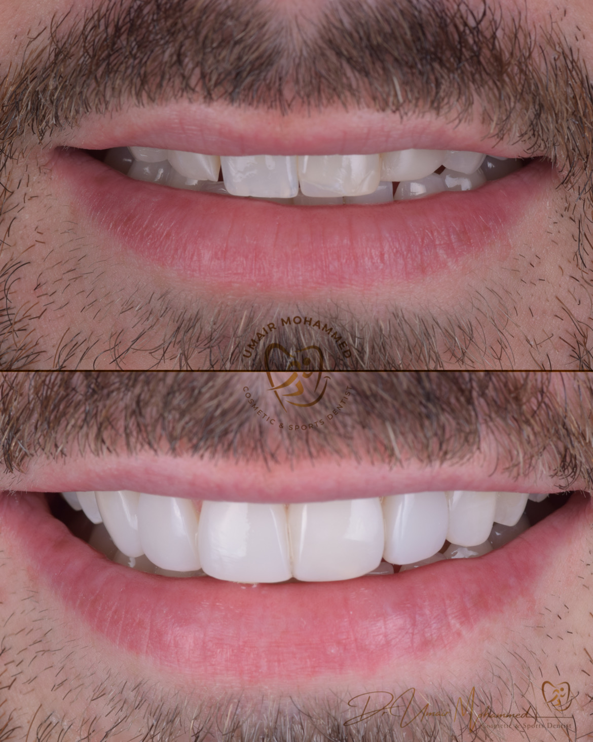 Before and After Patient Teeth 30