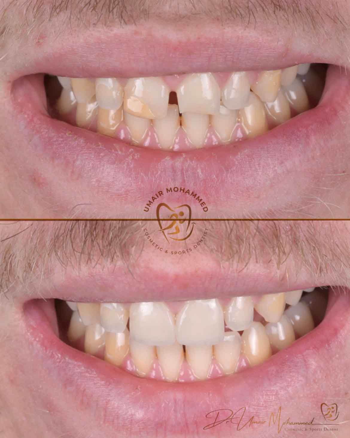 Before and After Patient Teeth 20