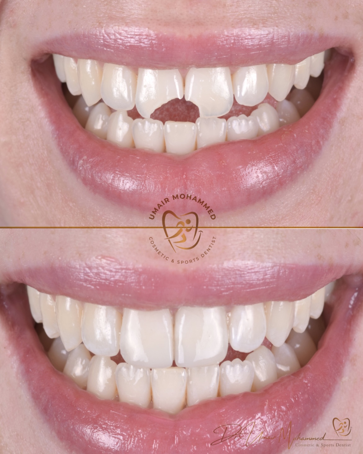 Before and After Patient Teeth 35