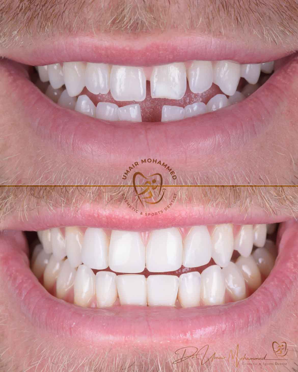 Before and After Patient Teeth 17