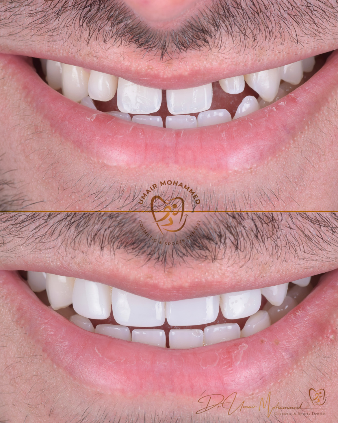Before and After Patient Teeth 32