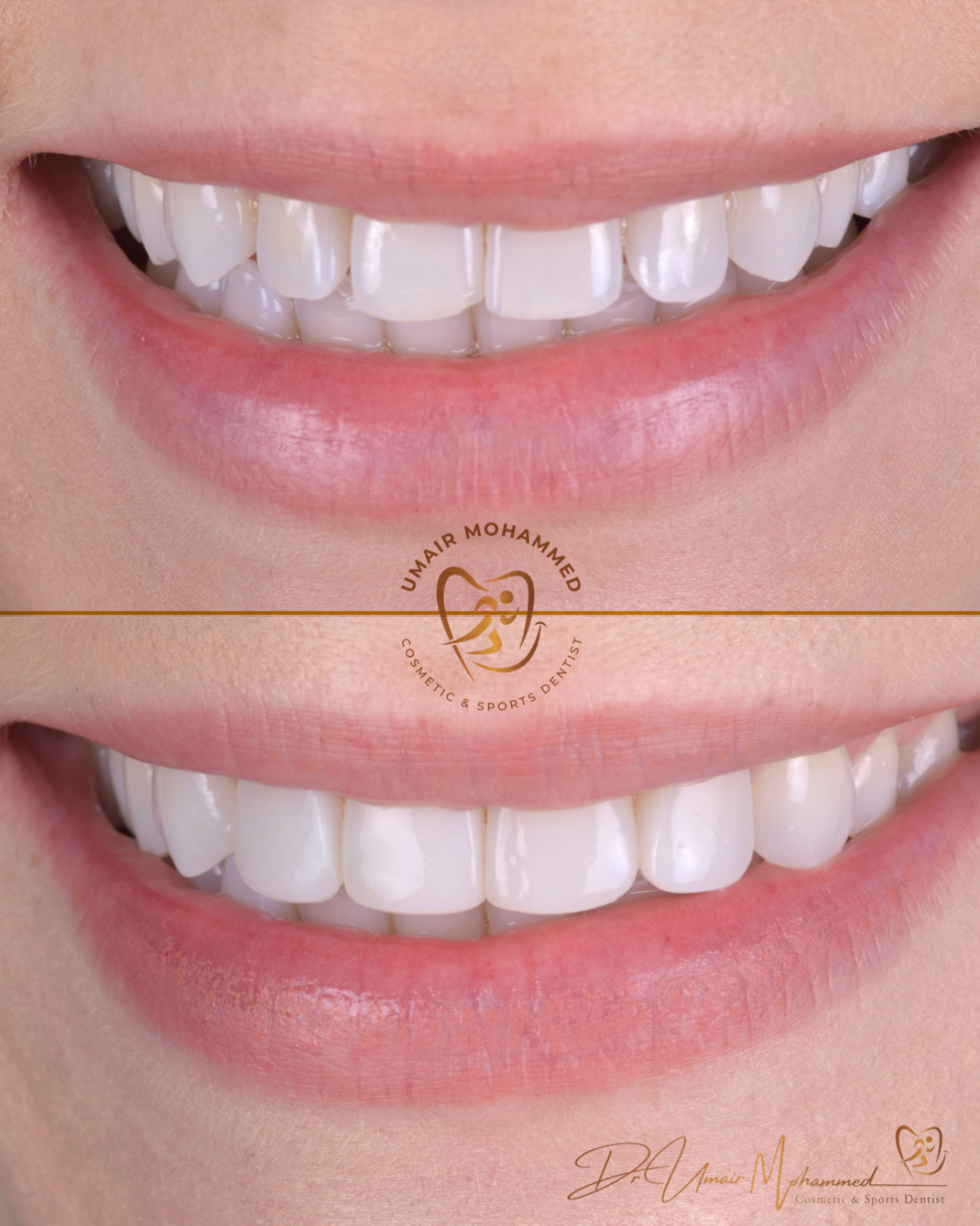 Before and After Patient Teeth 26