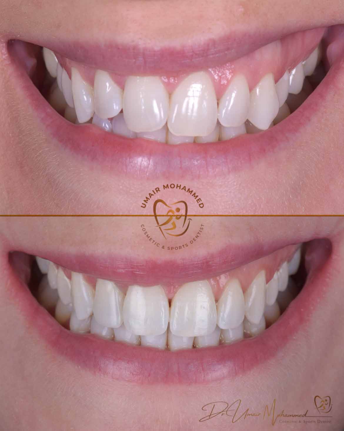 Before and After Patient Teeth 2
