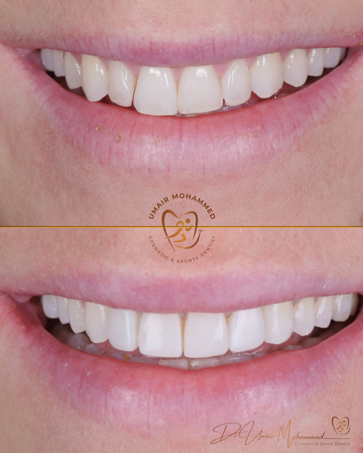 Before and After Patient Teeth 27