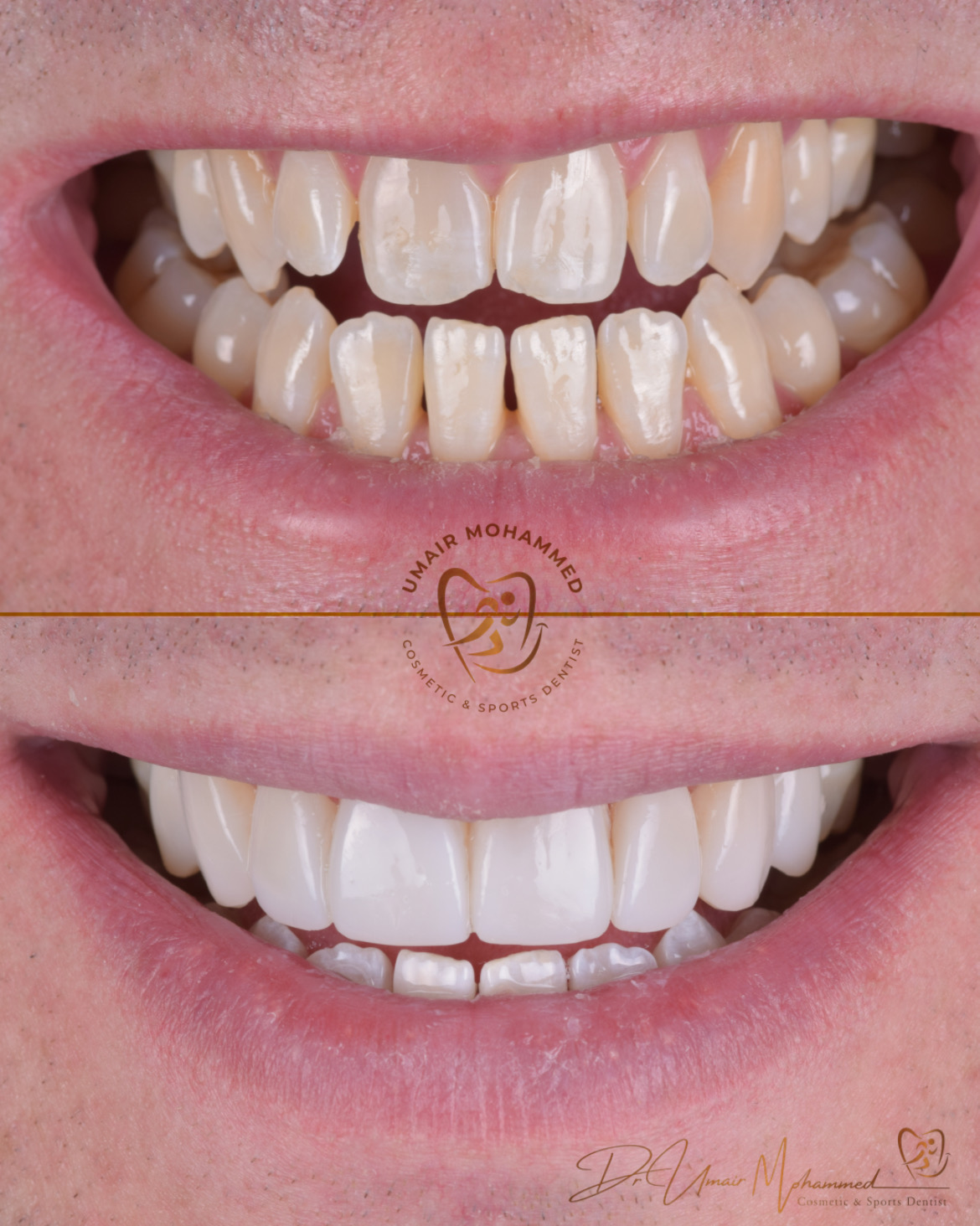 Before and After Patient Teeth 23