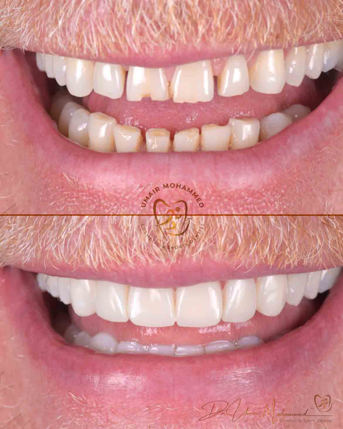 Before and After Patient Teeth 21