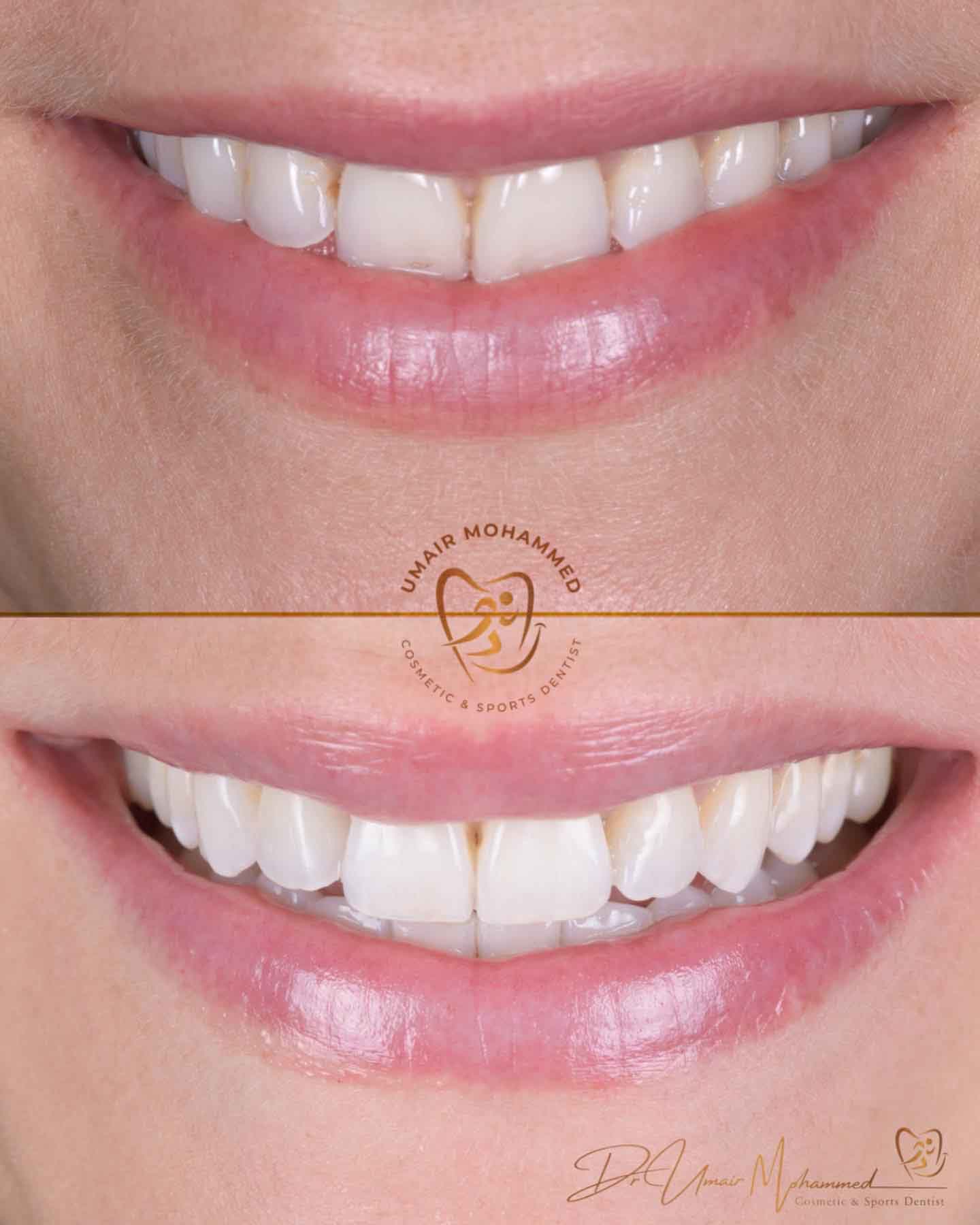 Before and After Patient Teeth 6