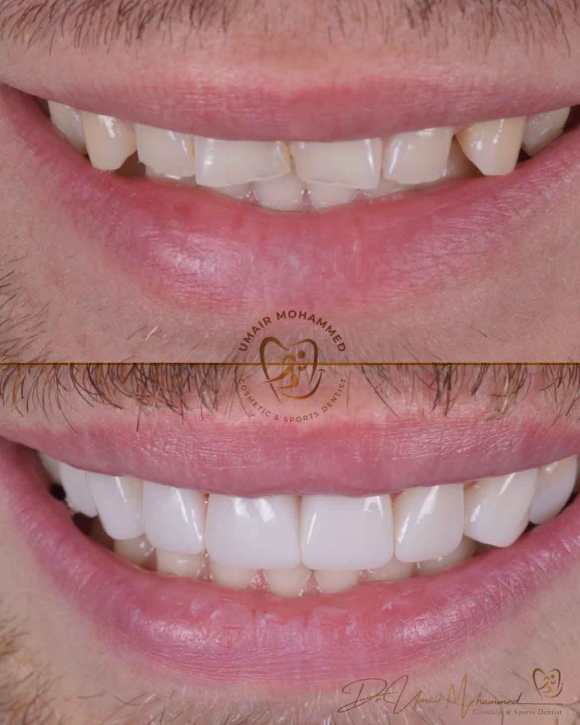 Before and After Patient Teeth 18