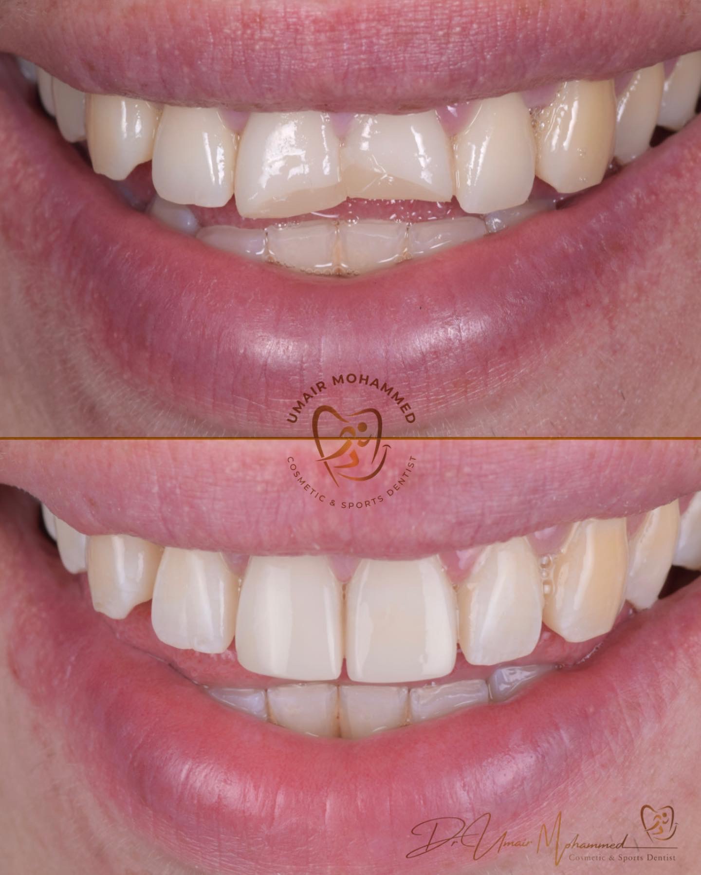 Before and After Patient Teeth 37