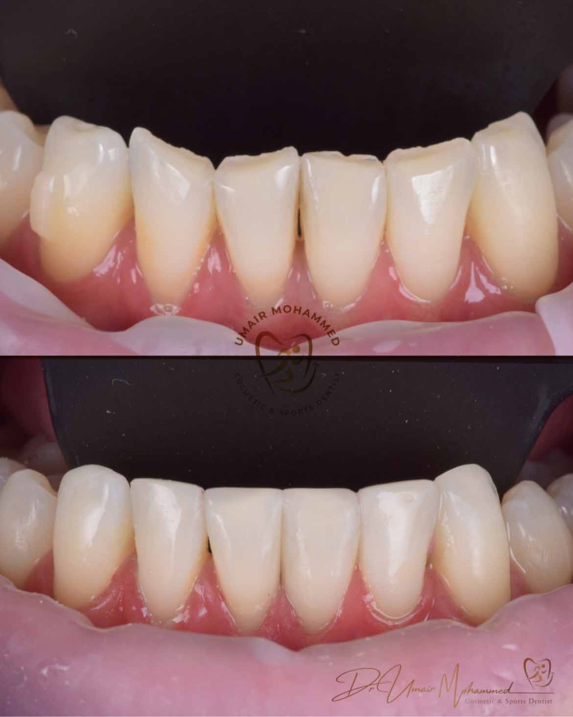 Before and After Patient Teeth 13