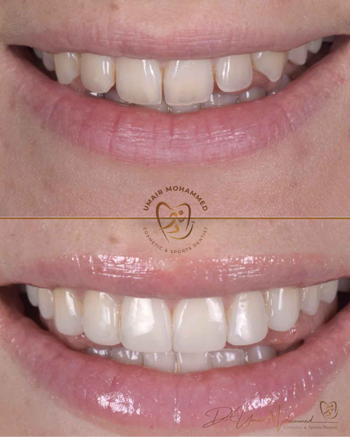Before and After Patient Teeth 3
