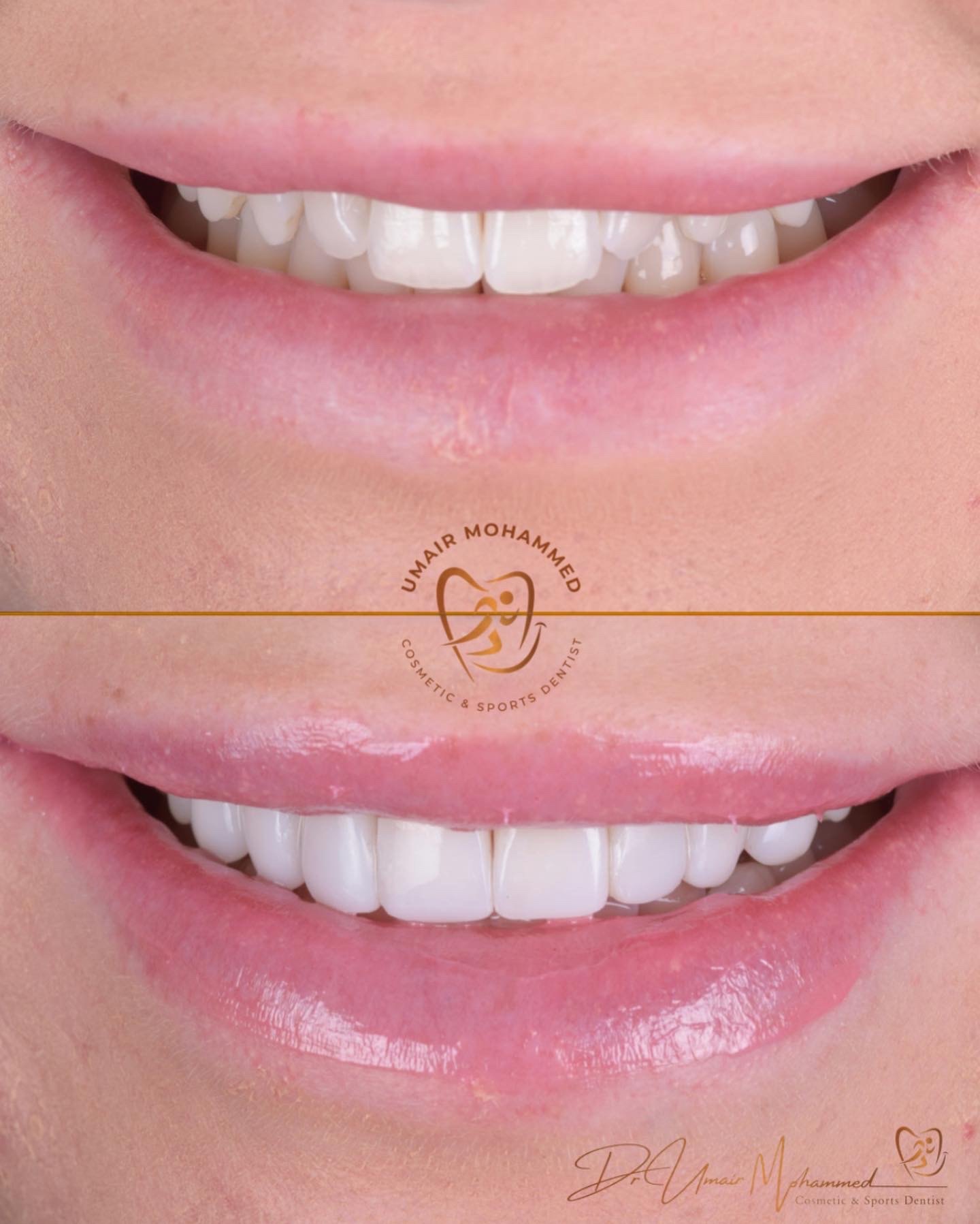 Before and After Patient Teeth 24