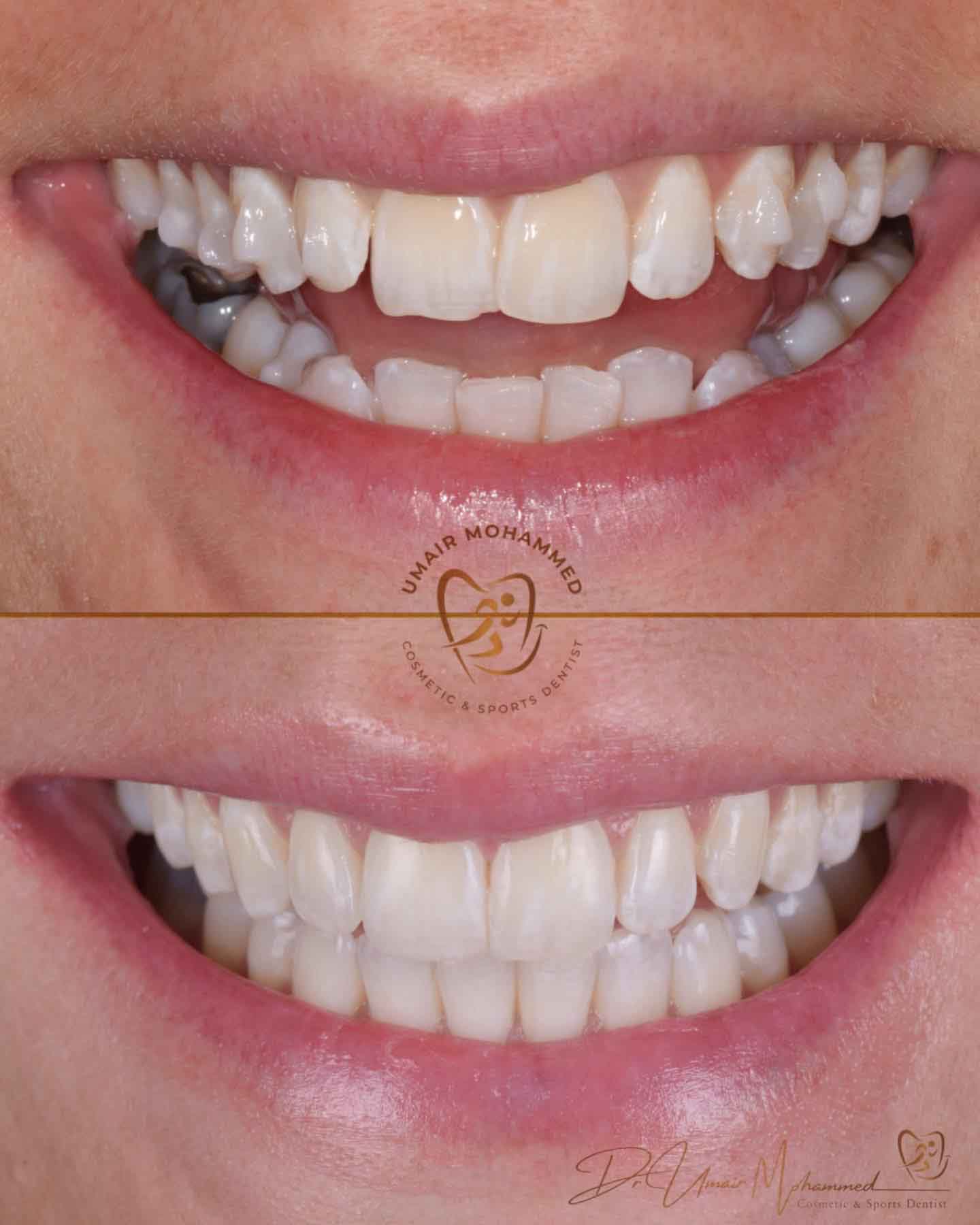 Before and After Patient Teeth 5