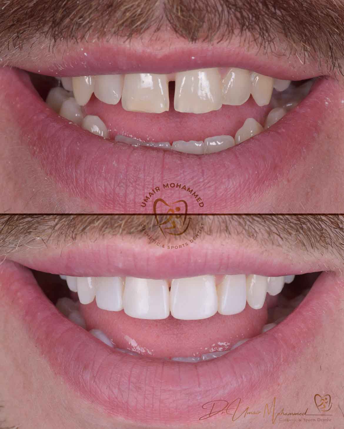 Before and After Patient Teeth 16