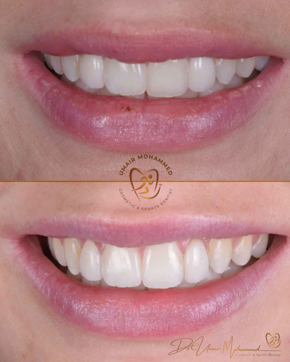 Before and After Patient Teeth 8
