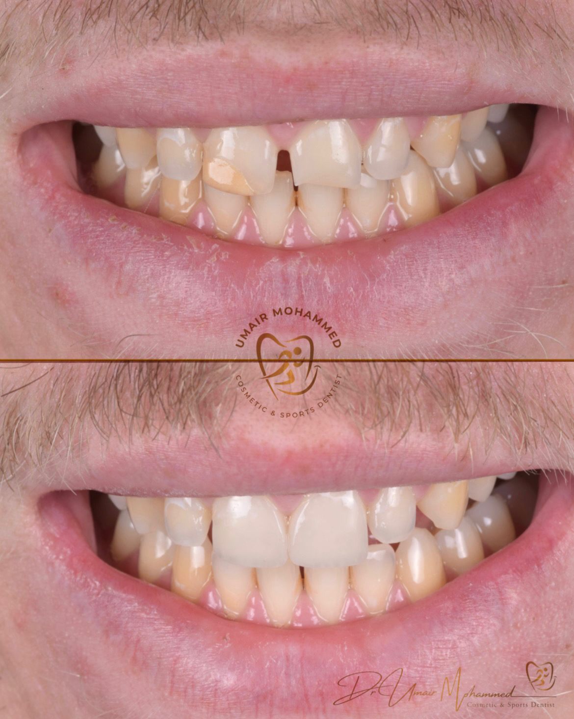 Before and After Patient Teeth 38