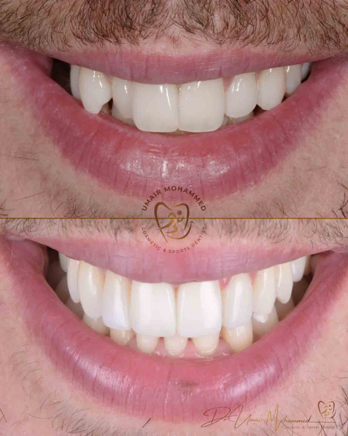 Before and After Patient Teeth 10