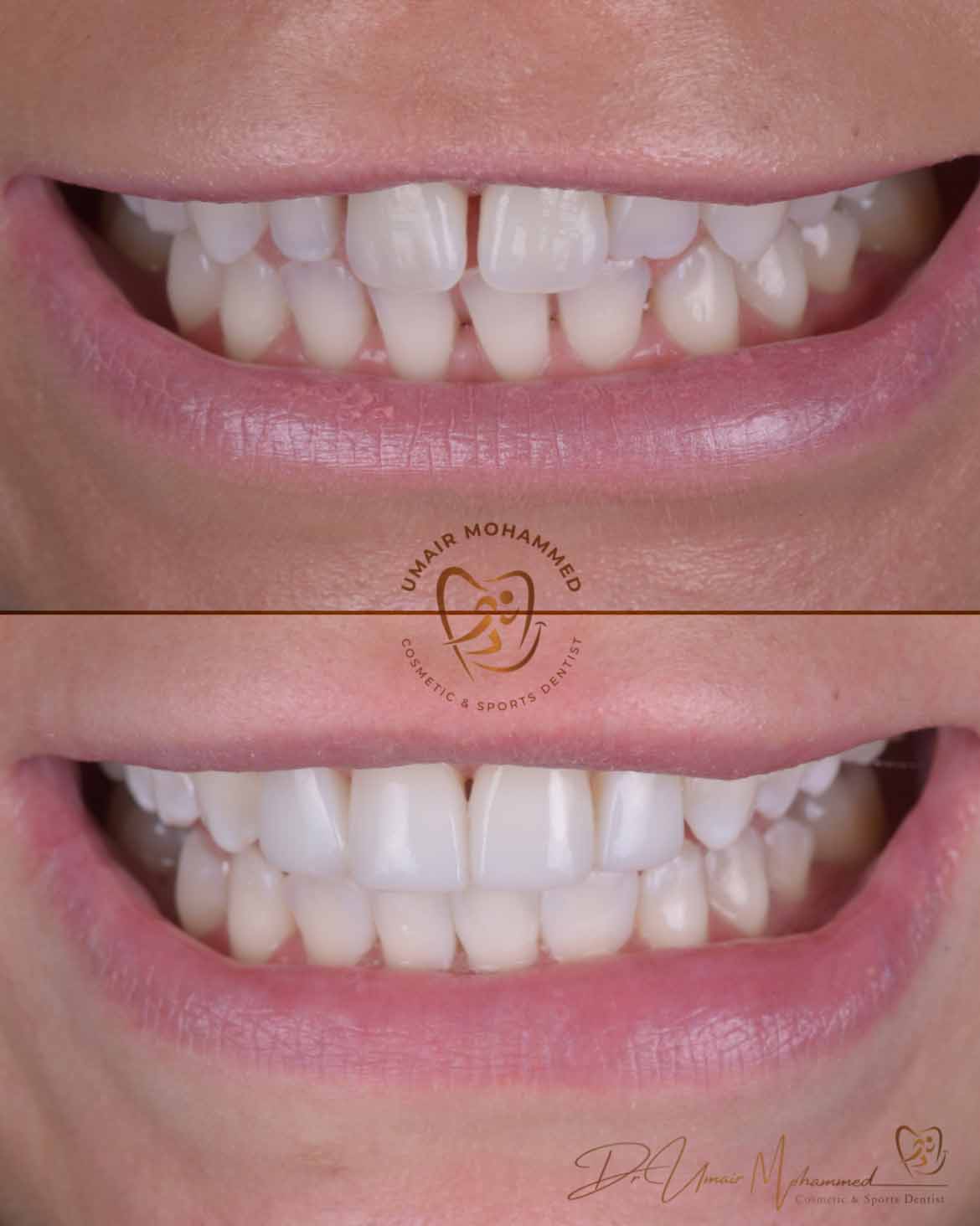 Before and After Patient Teeth 15