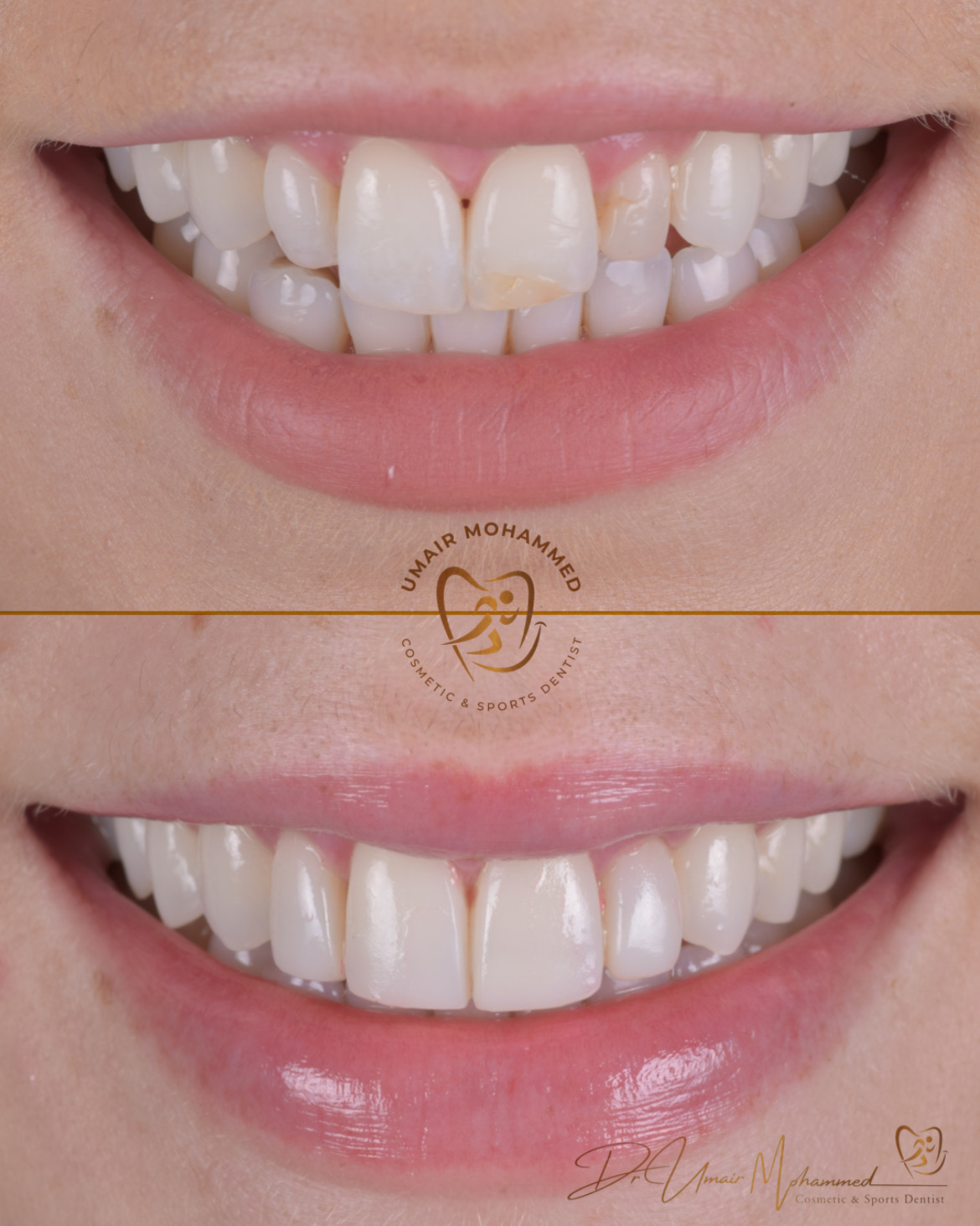 Before and After Patient Teeth 29