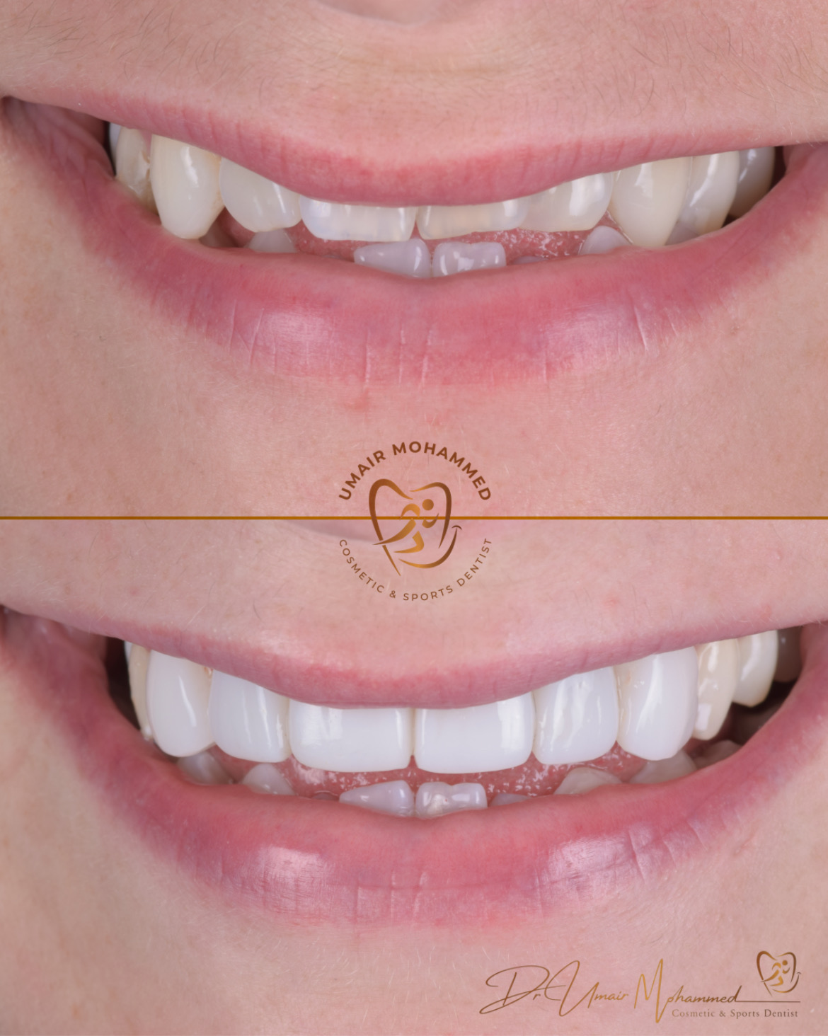 Before and After Patient Teeth 25