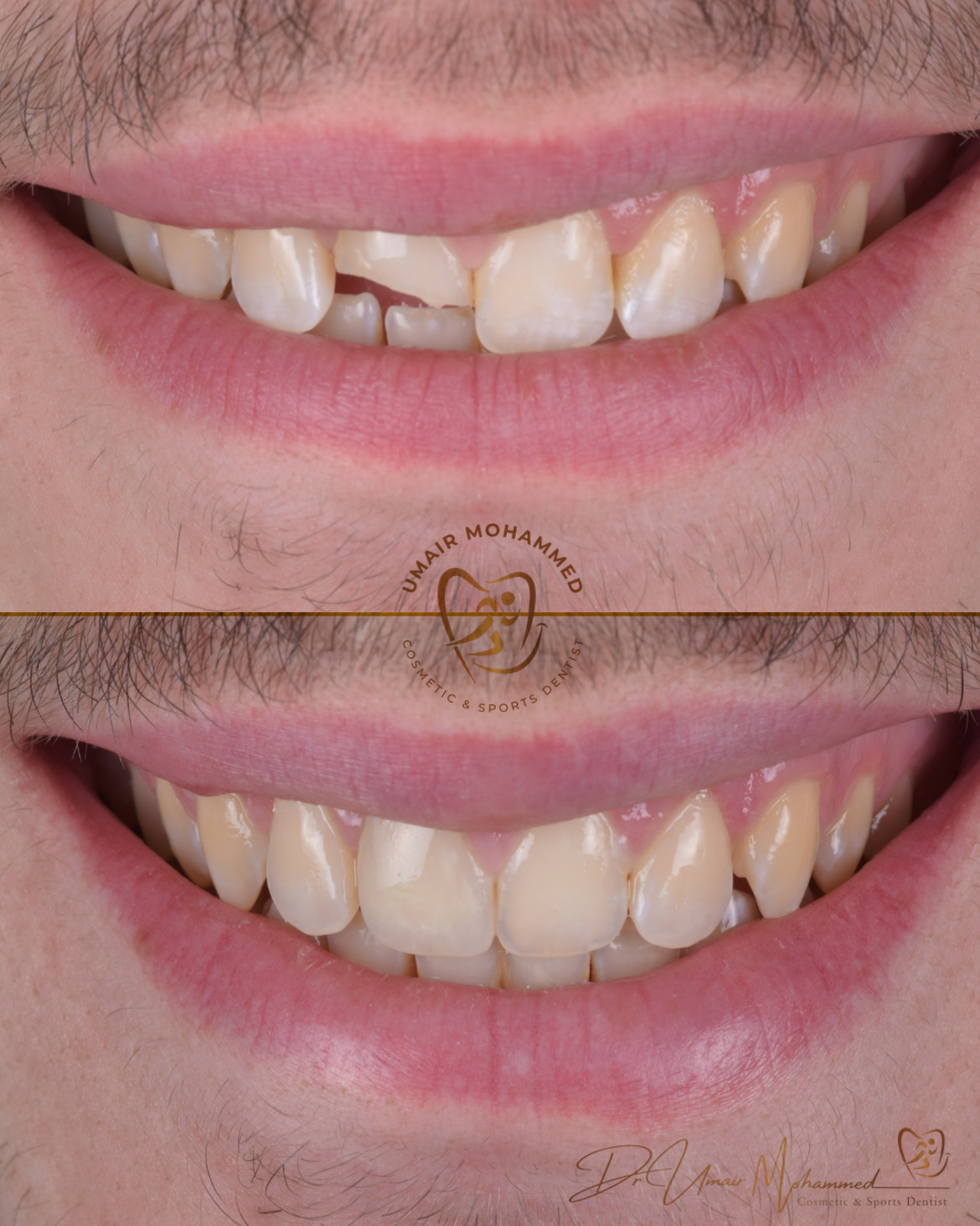 Before and After Patient Teeth 40
