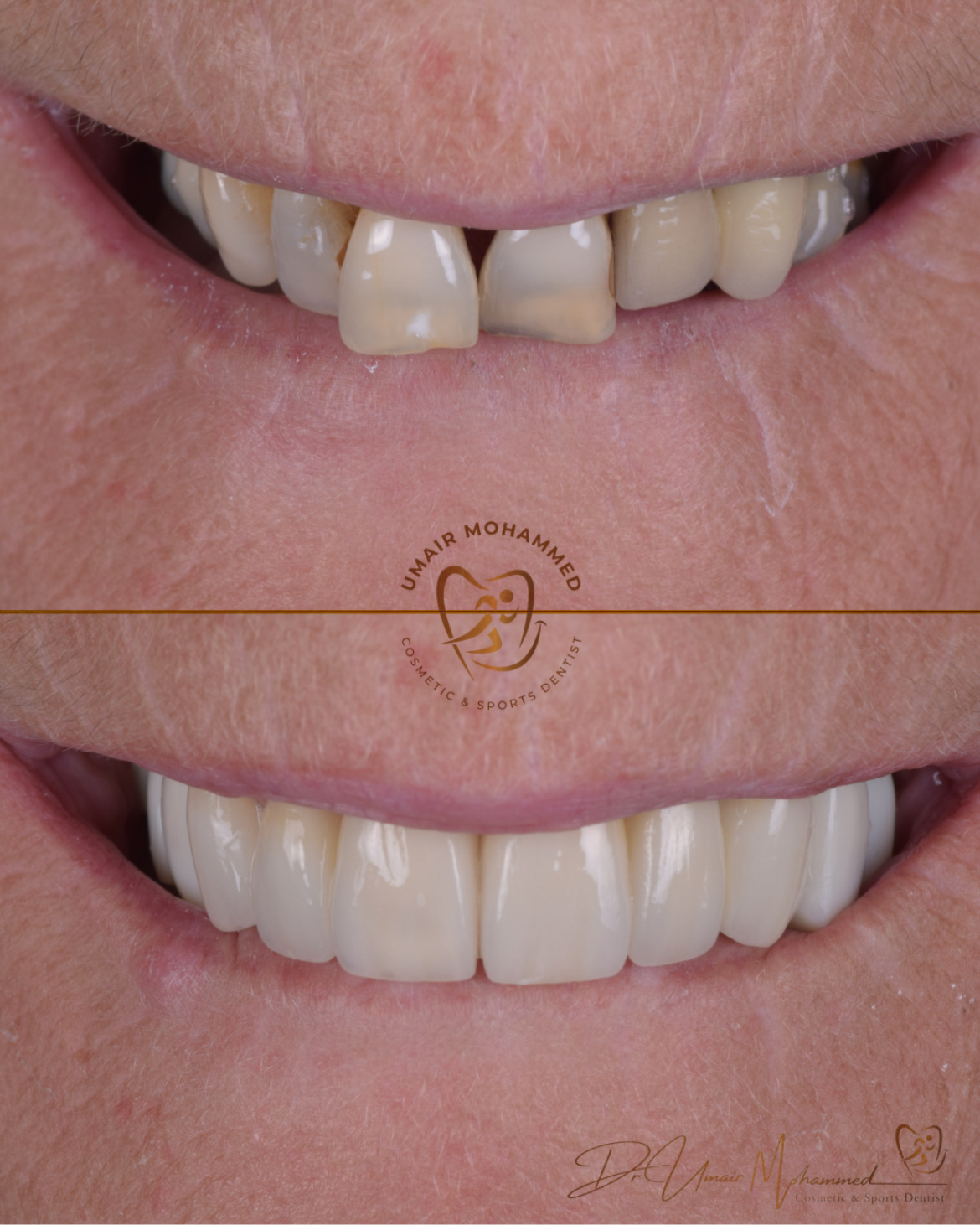 Before and After Patient Teeth 41