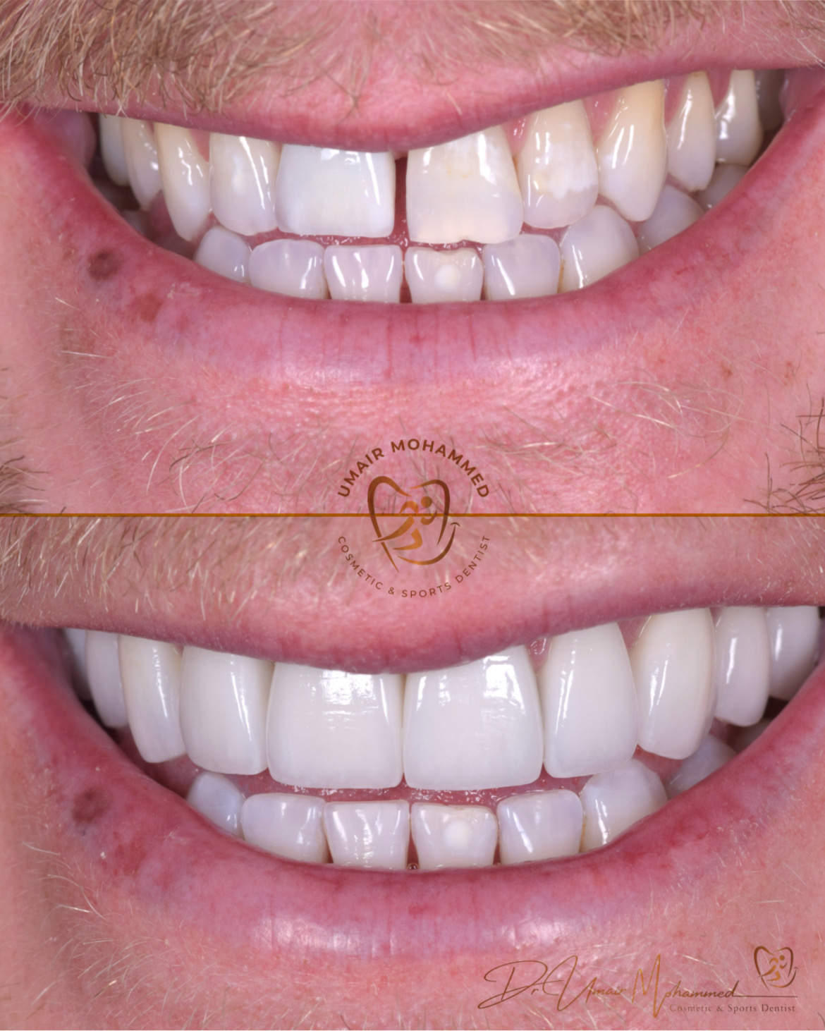 Before and After Patient Teeth 42