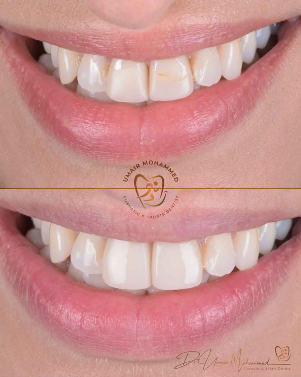 Before and After Patient Teeth 14