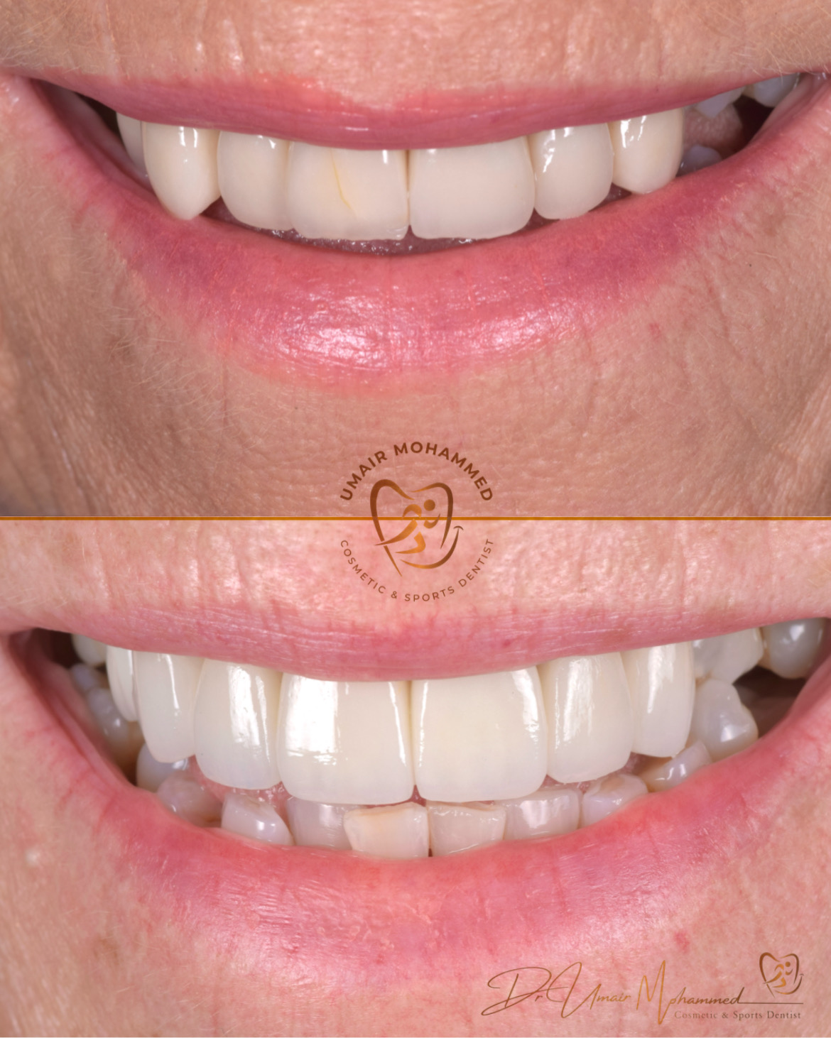 Before and After Patient Teeth 43