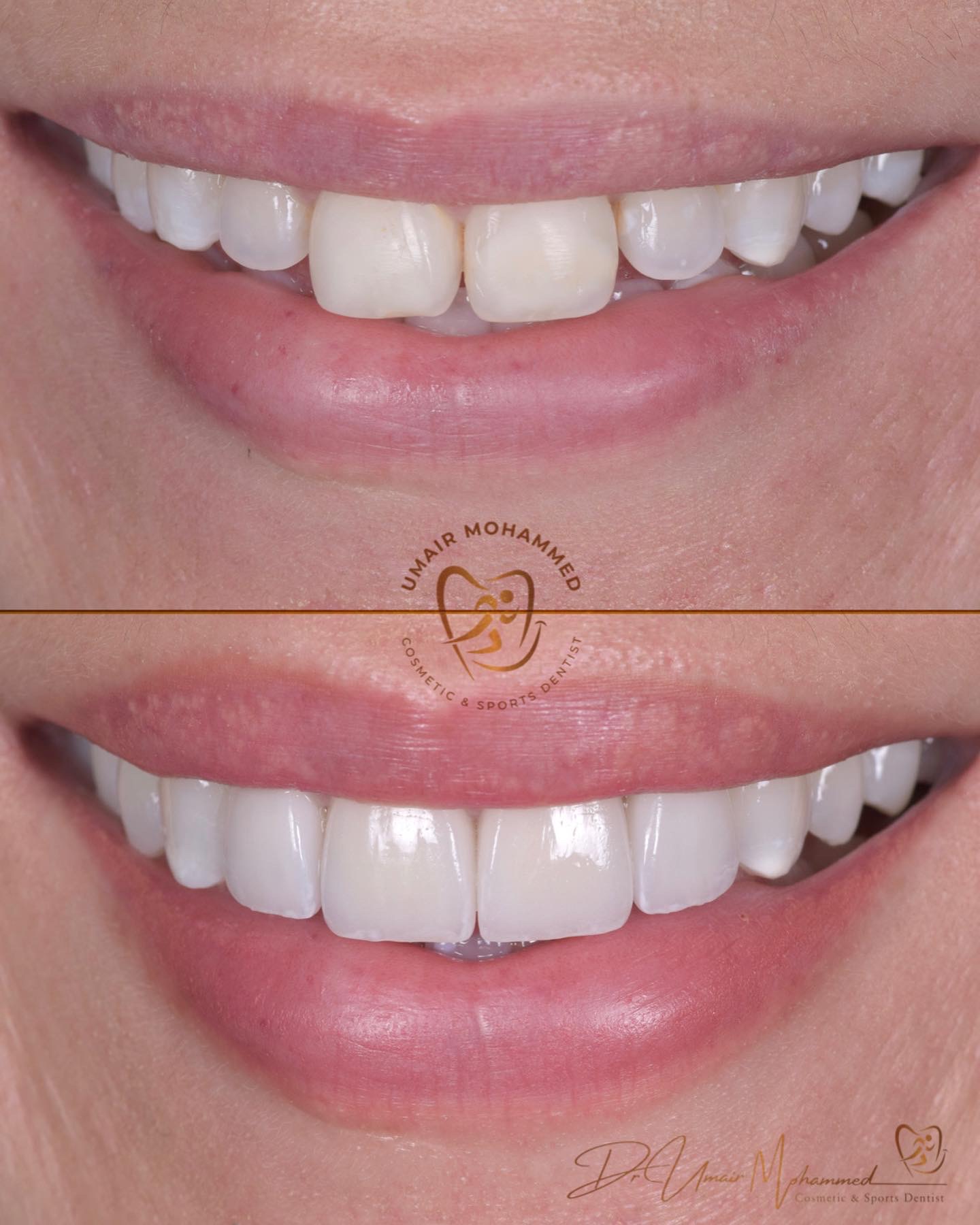 Before and After Patient Teeth 44
