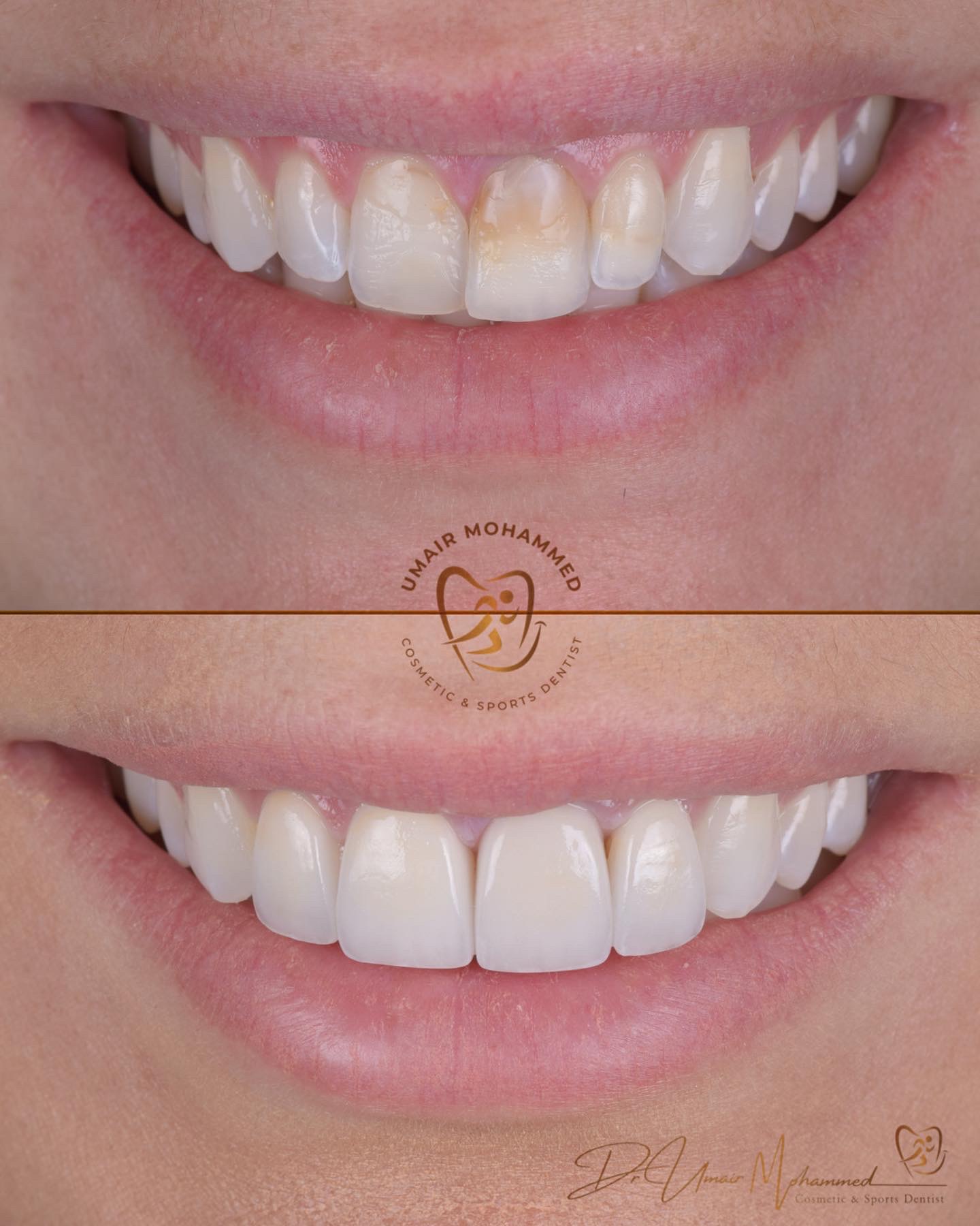 Before and After Patient Teeth 45