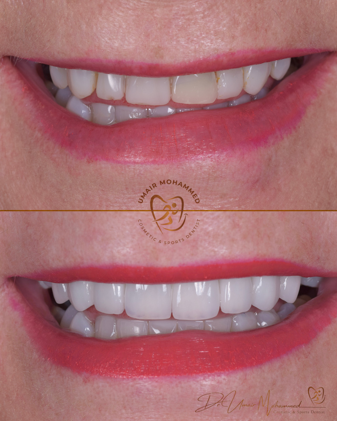 Before and After Patient Teeth 46