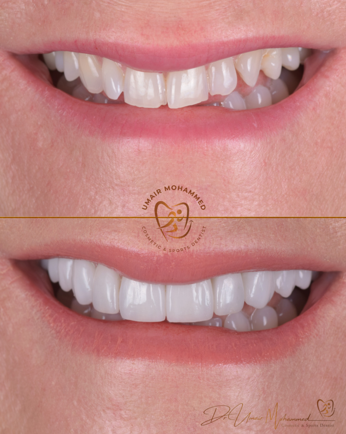 Before and After Patient Teeth 47