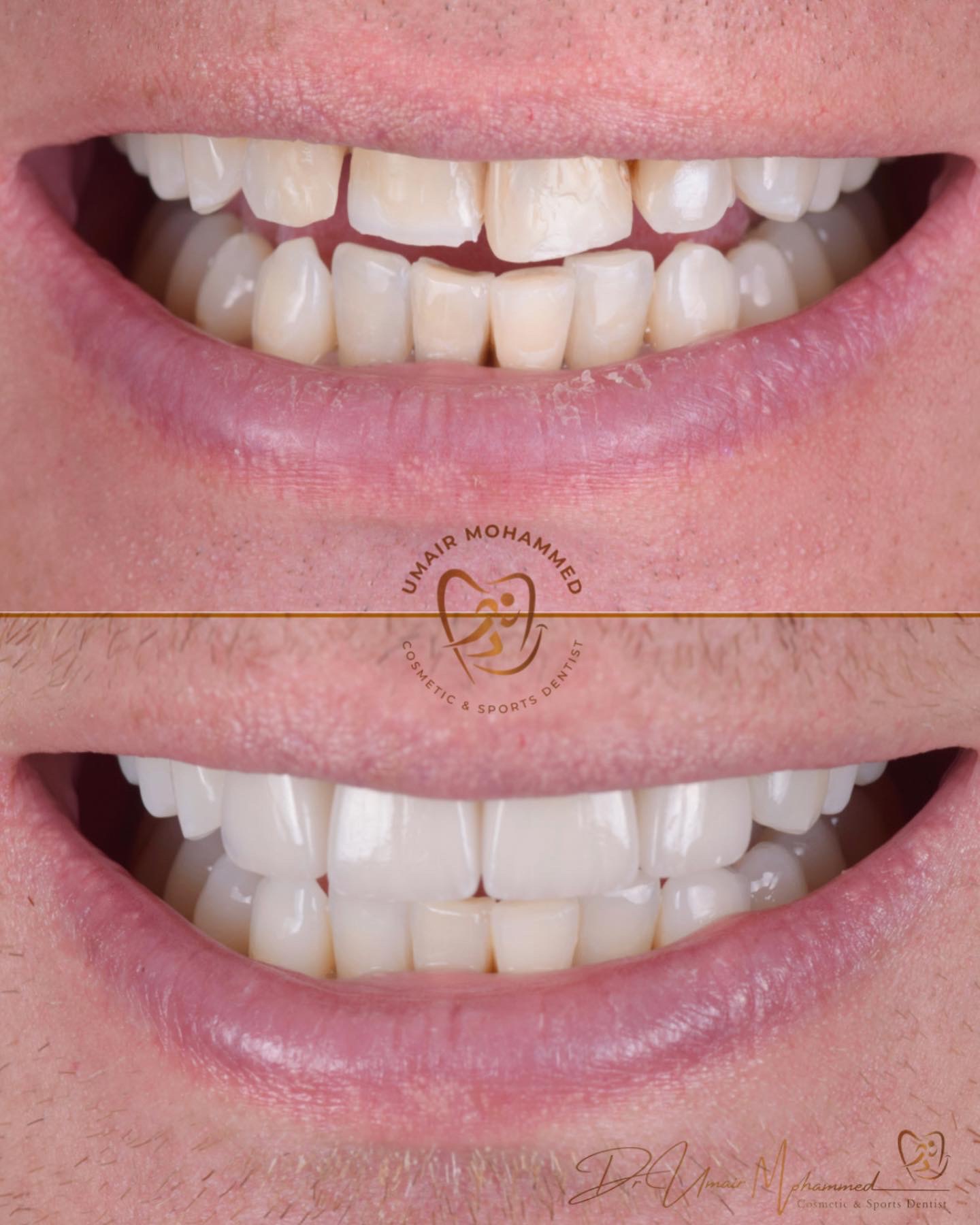 Before and After Patient Teeth 48