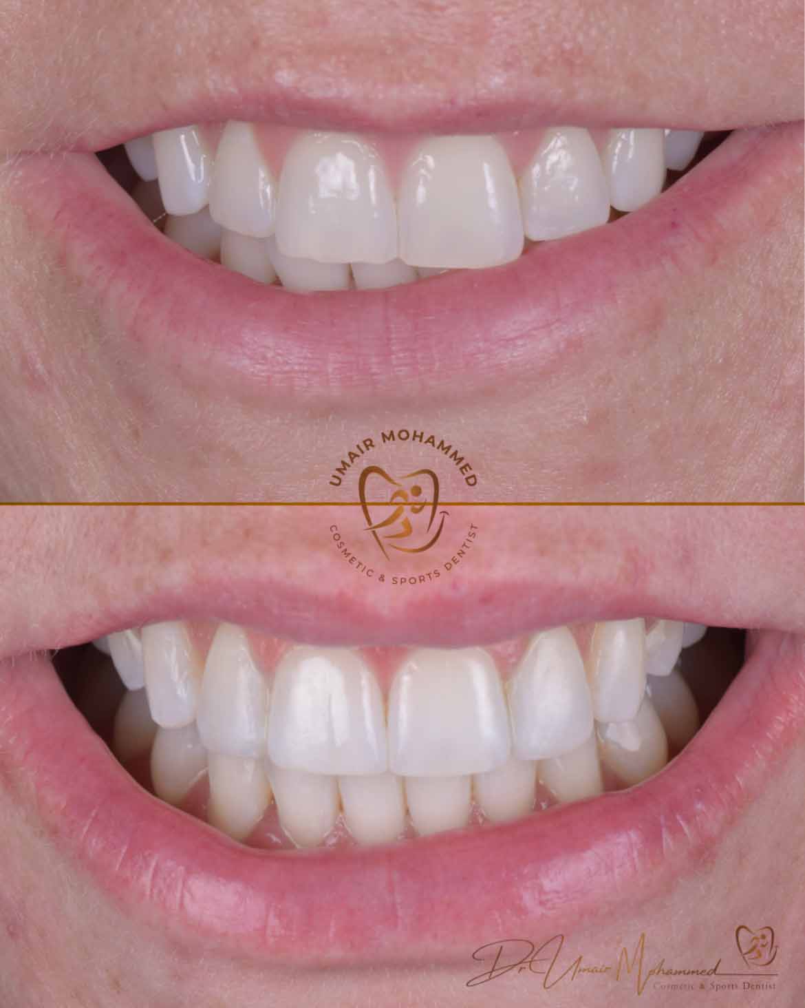 Before and After Patient Teeth 9