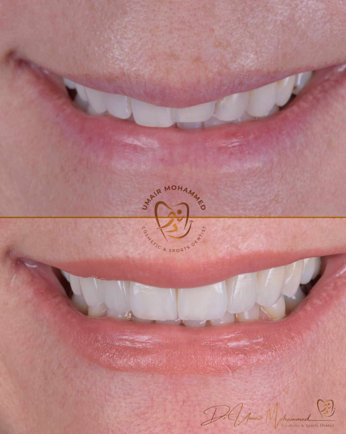 Before and After Patient Teeth 49