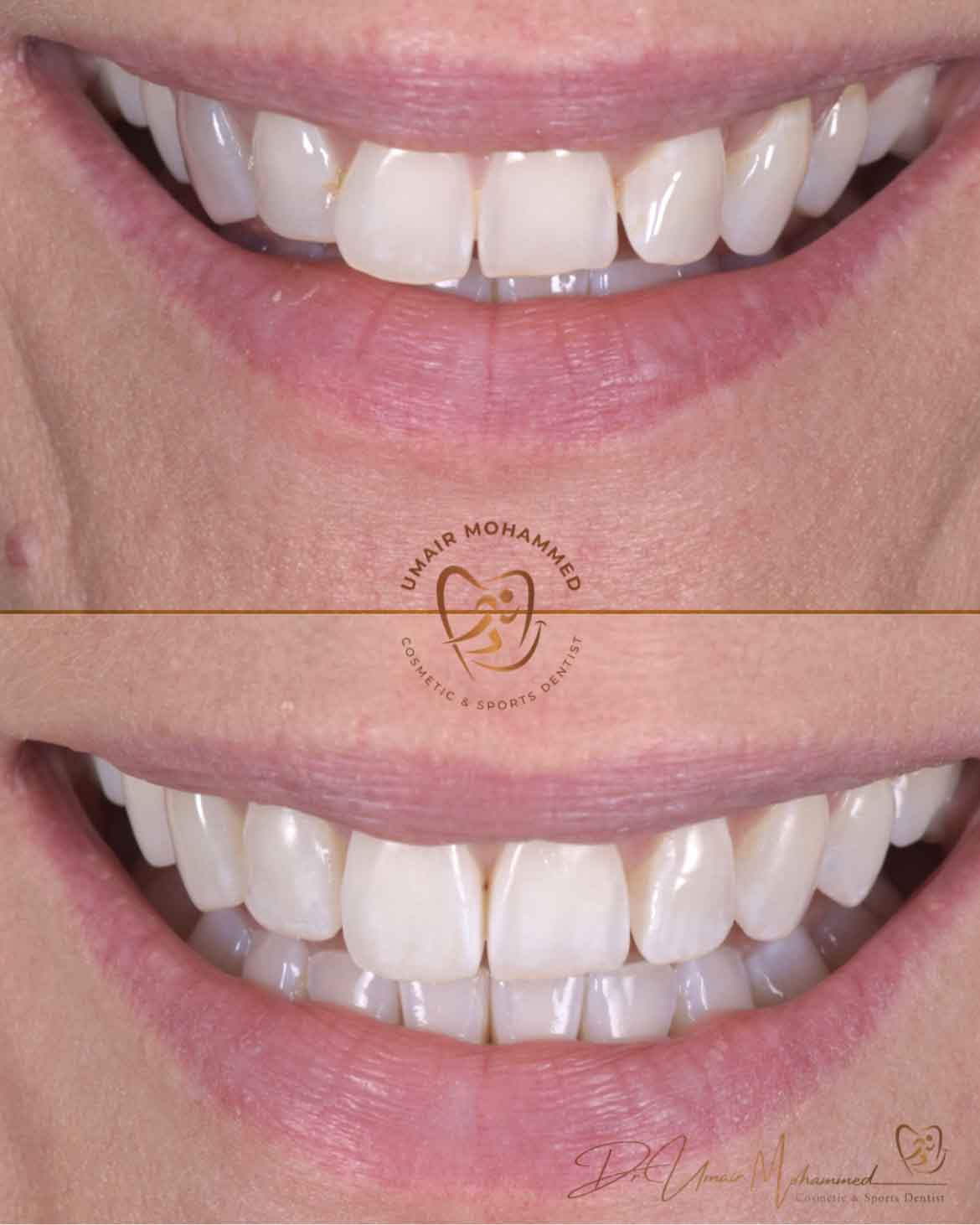 Before and After Patient Teeth 4