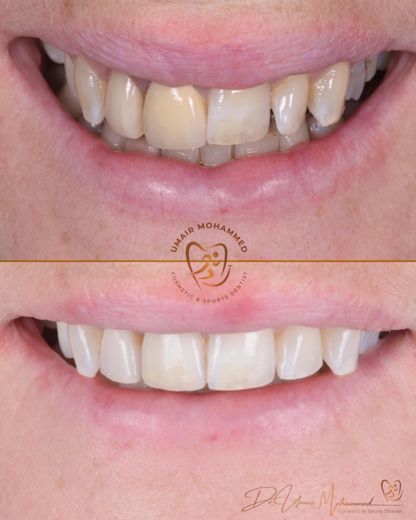 Before and After Patient Teeth 50