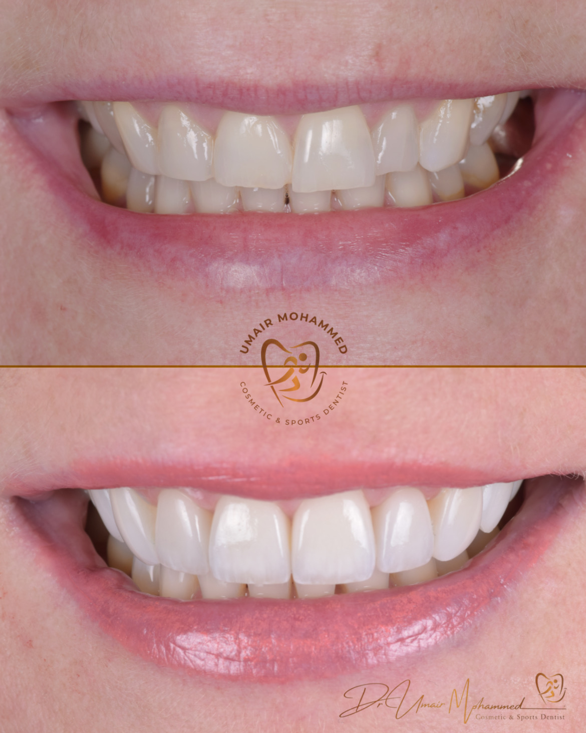 Before and After Patient Teeth 51