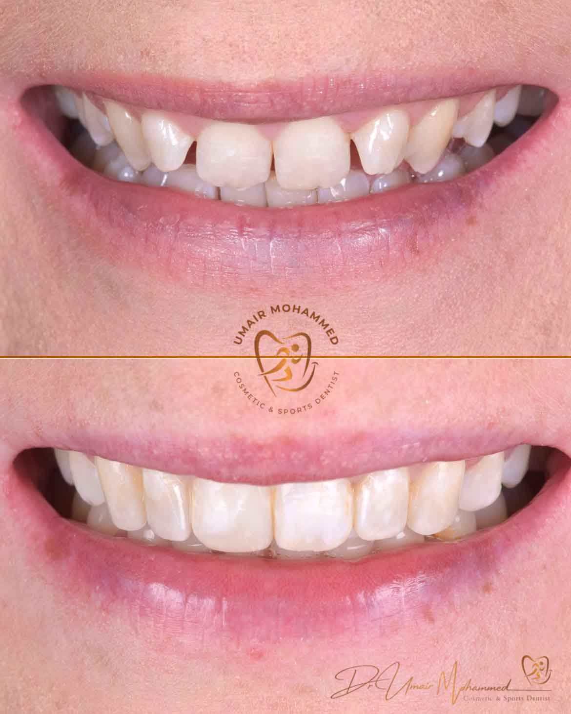 Before and After Patient Teeth 12
