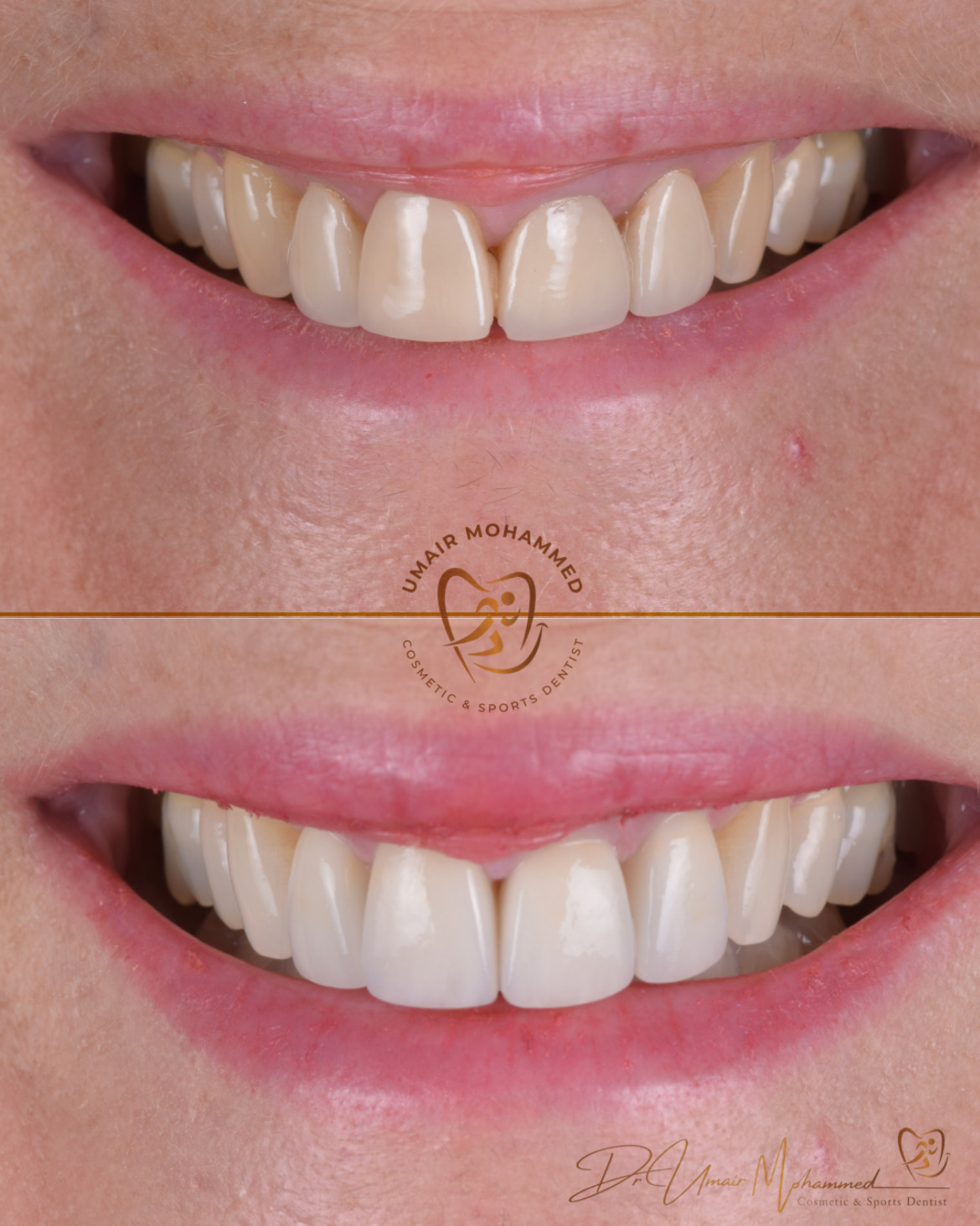 Before and After Patient Teeth 52