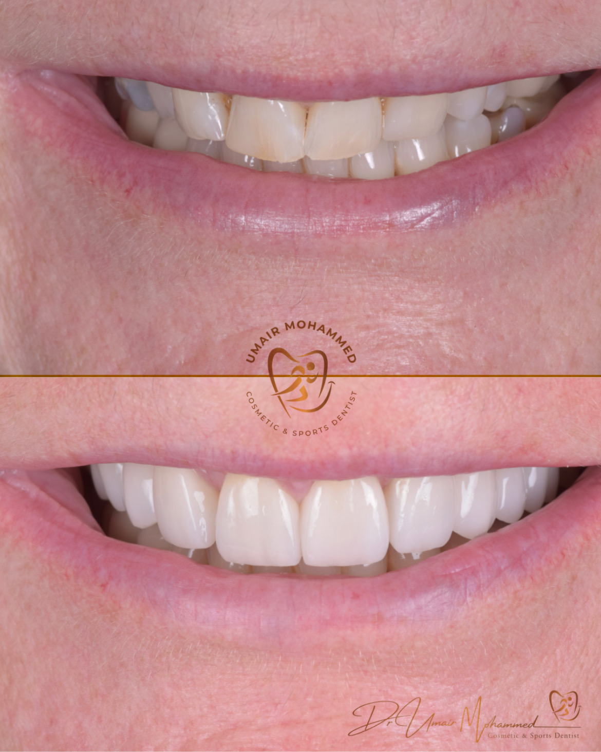 Before and After Patient Teeth 53