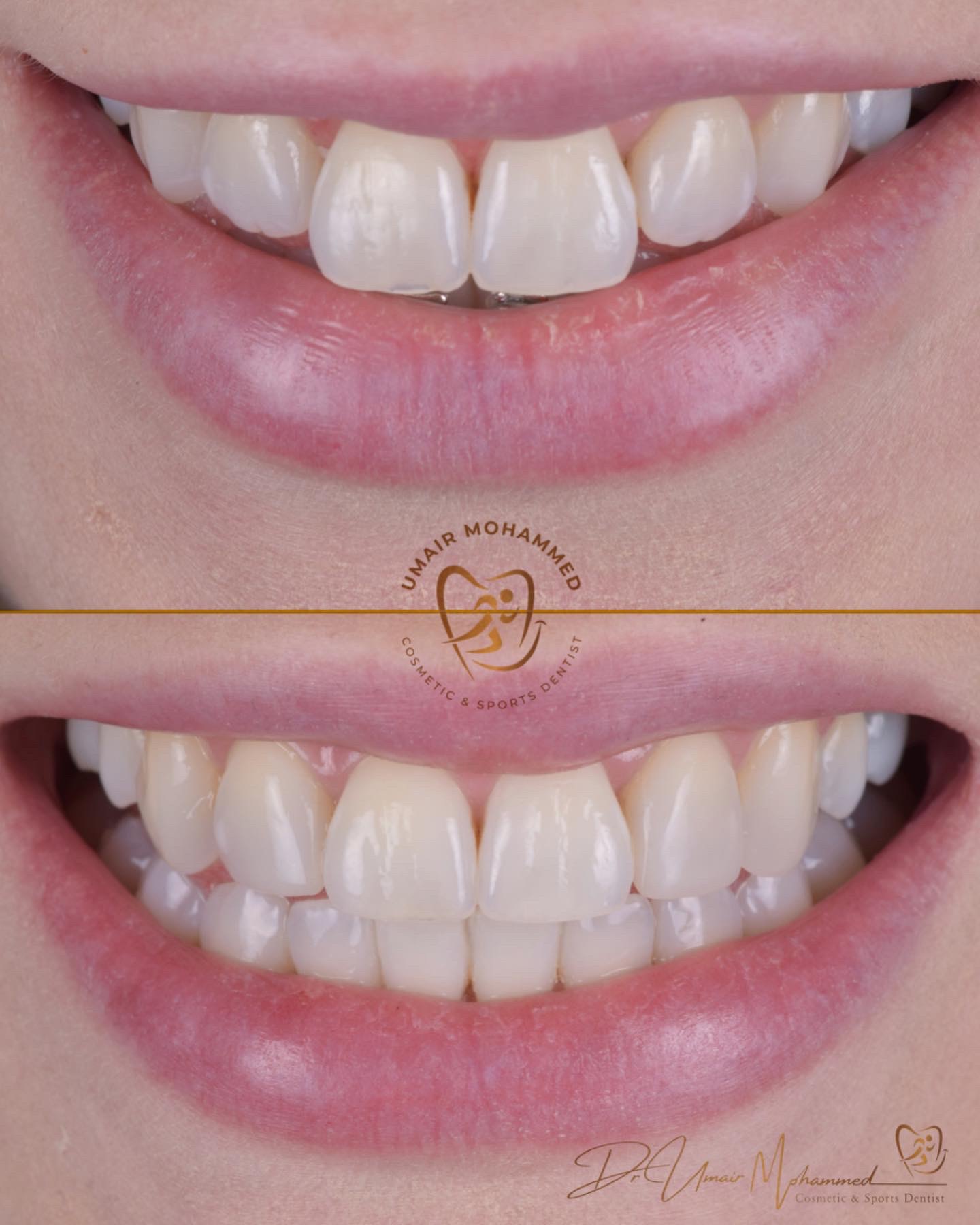 Before and After Patient Teeth 28