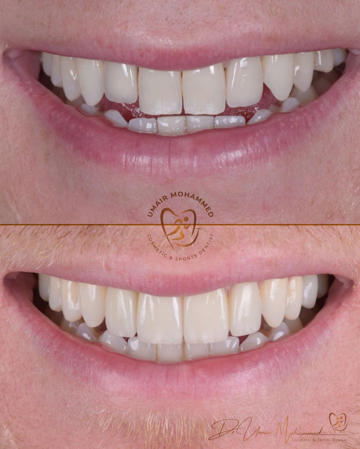 Before and After Patient Teeth 54