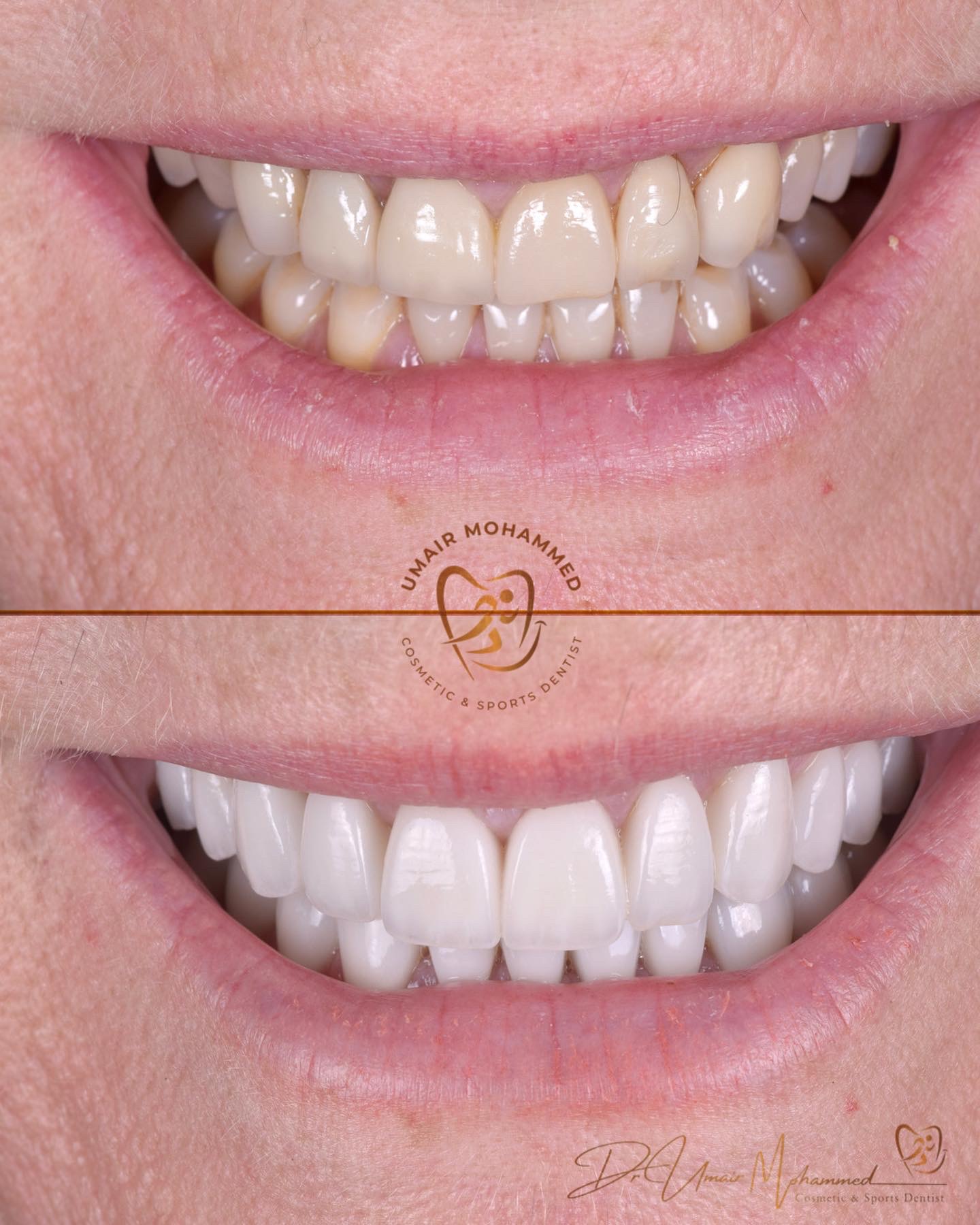 Before and After Patient Teeth 55