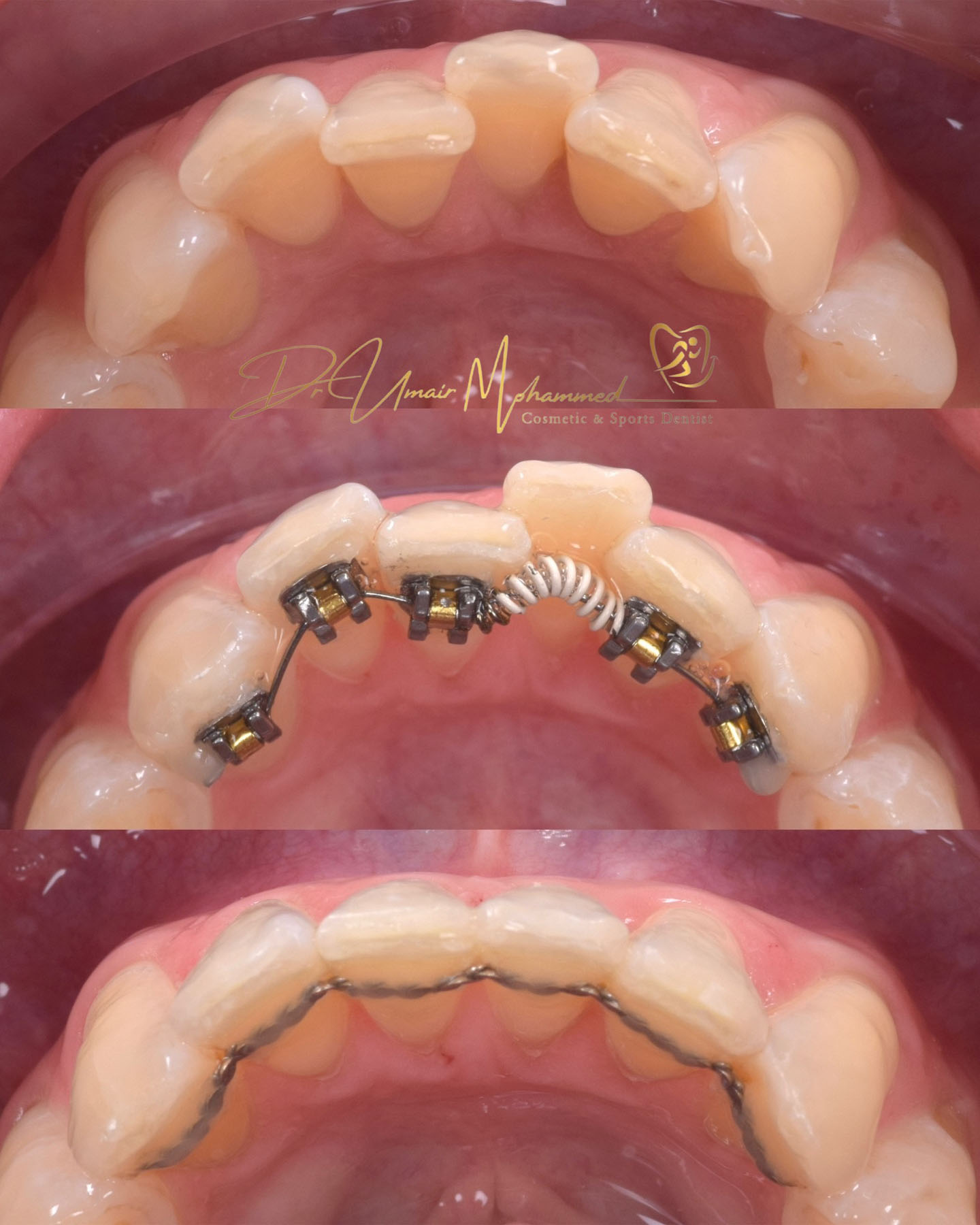 Before and After Patient Teeth 56