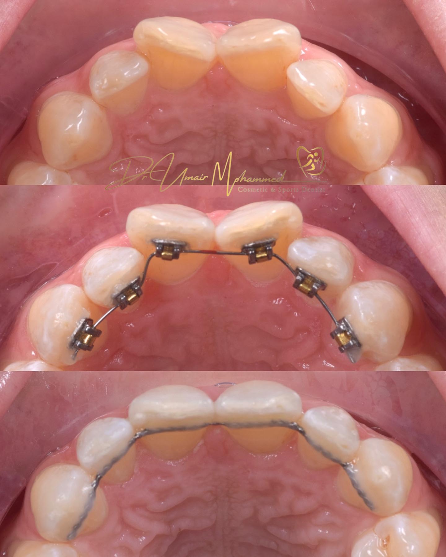 Before and After Patient Teeth 57