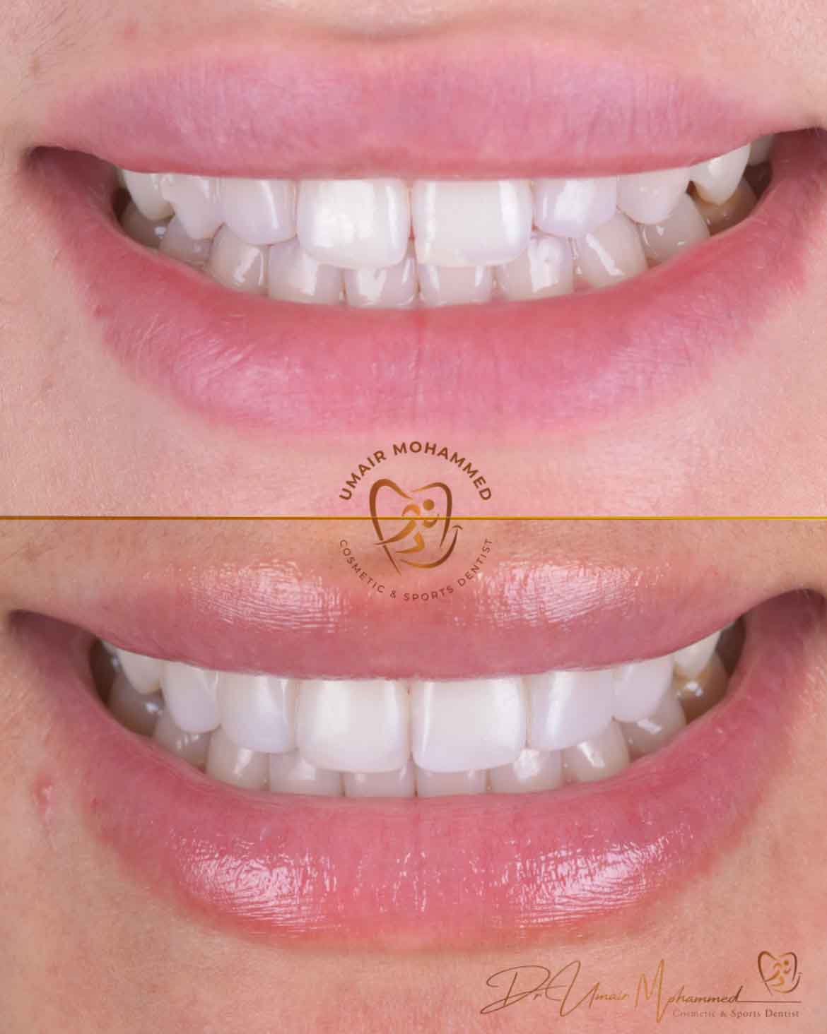 Before and After Patient Teeth 22