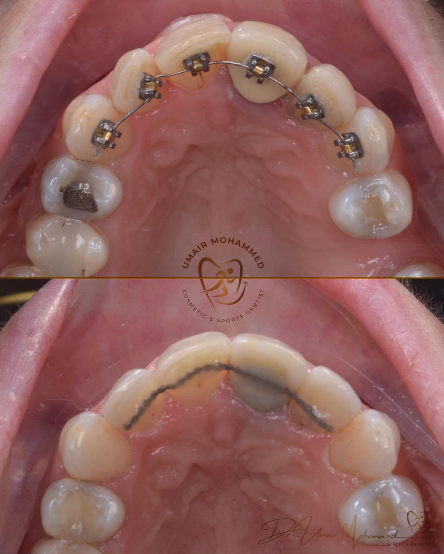 Before and After Patient Teeth 58